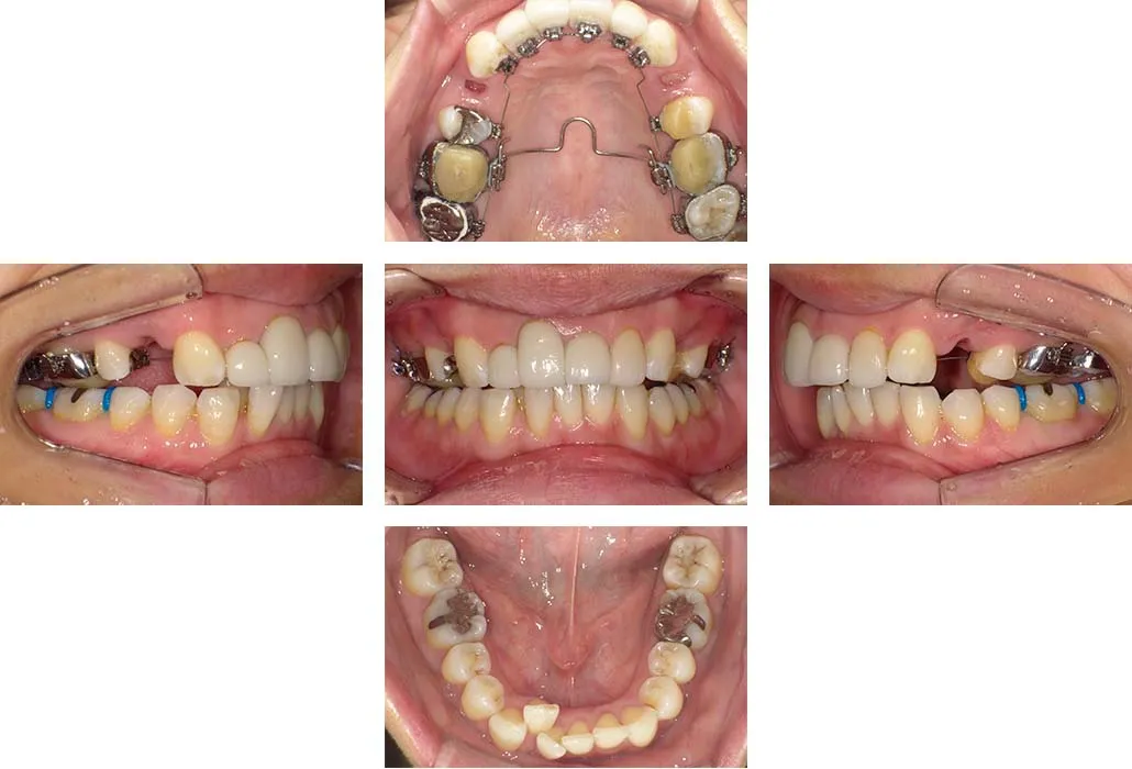治療経過（動的治療開始時）