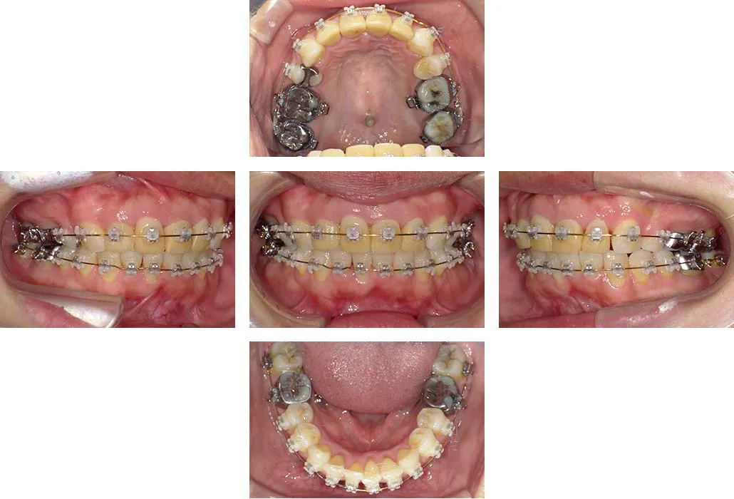 治療経過（動的治療終了時）