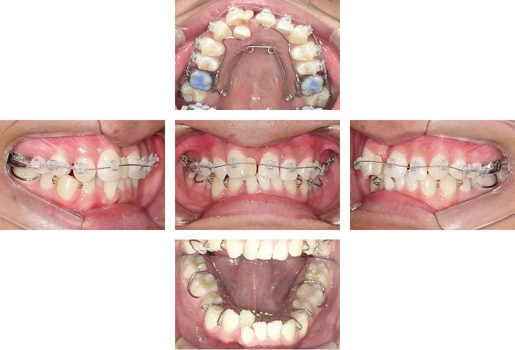 治療経過（動的治療開始時）