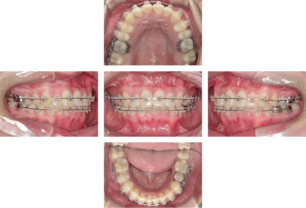 治療経過（動的治療終了時）