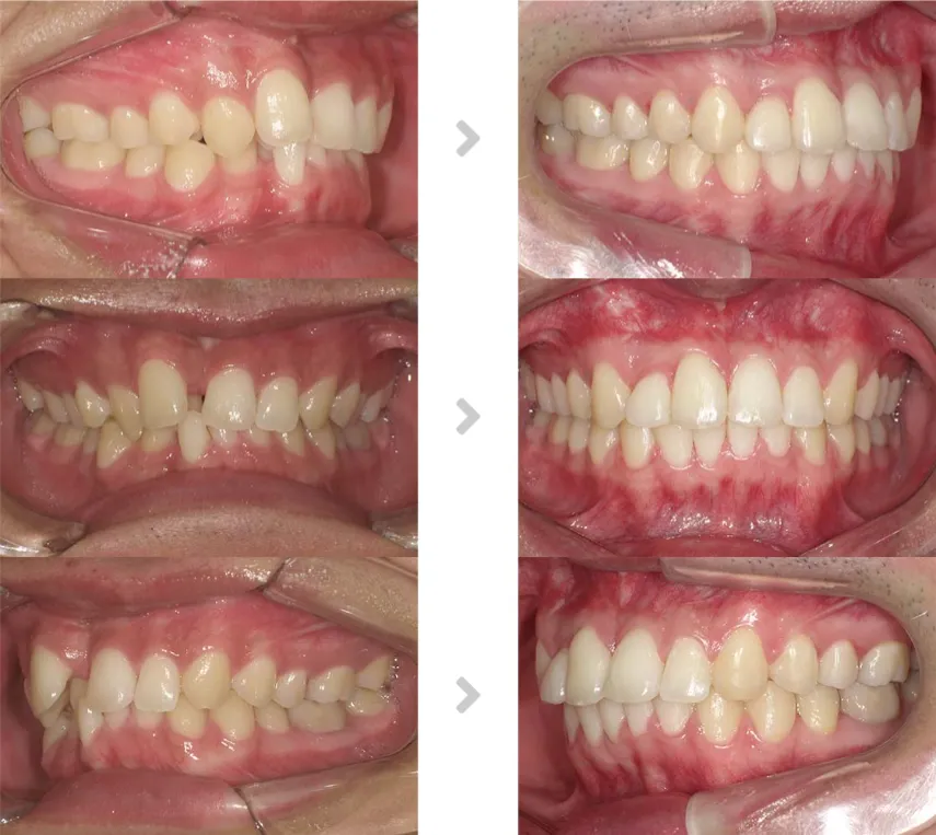 術前術後の比較