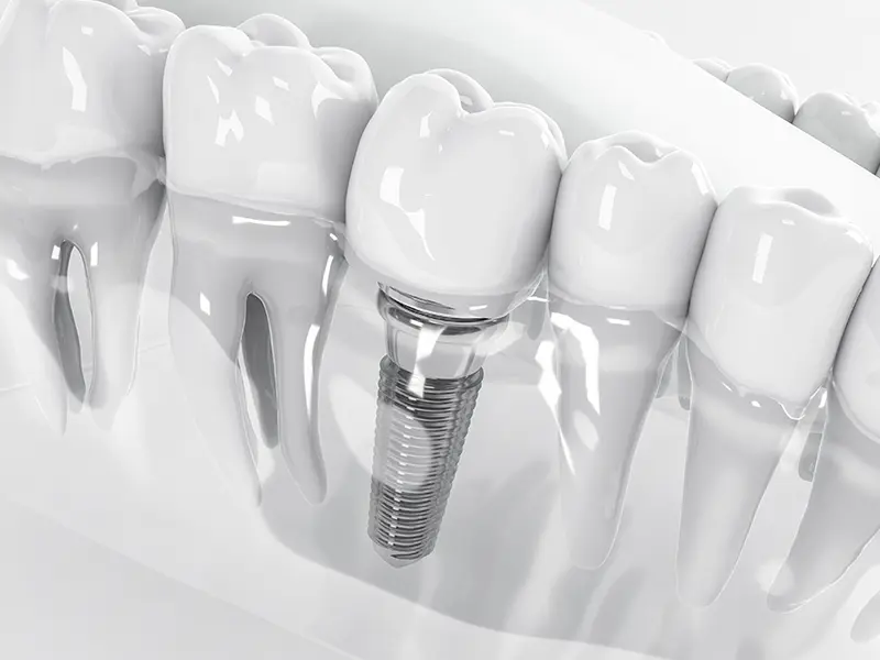 インプラント治療