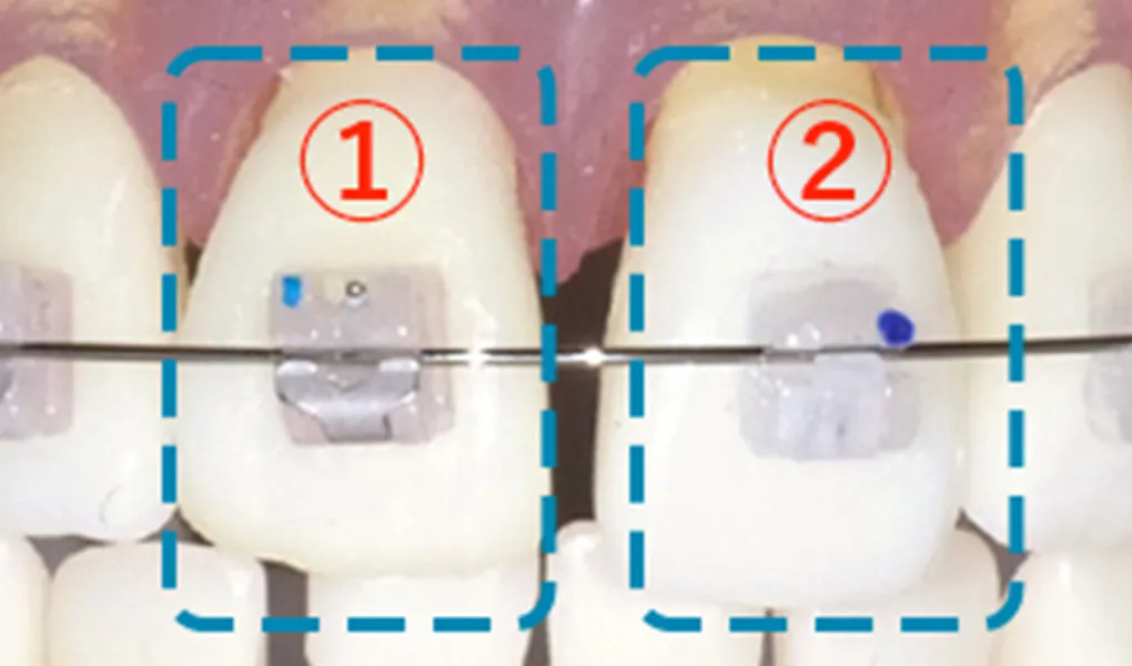 表側矯正の装置の種類