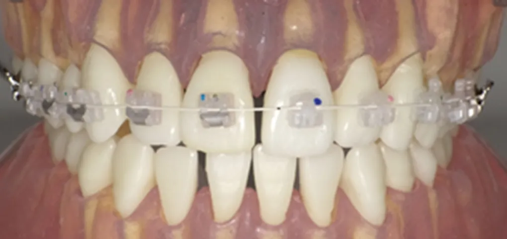 ホワイトコーティングワイヤー