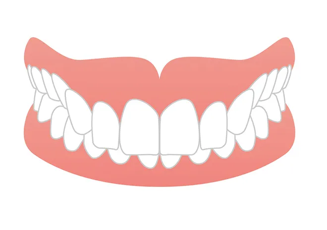 過蓋（かがい）咬合