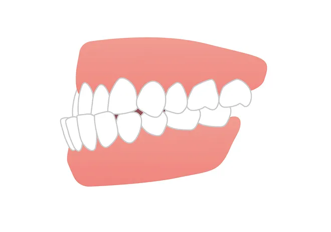 下顎前突（受け口）