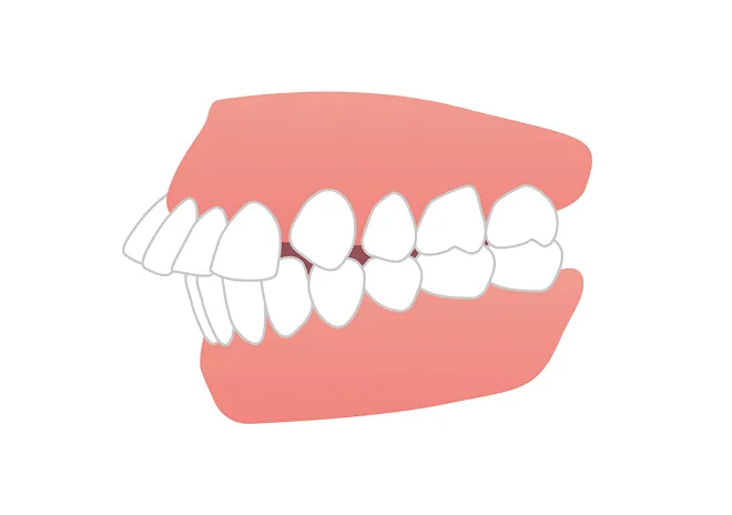 上顎前突（出っ歯）