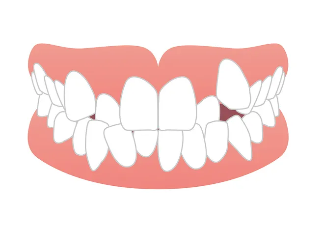 叢生（そうせい：ガタガタの歯並び）