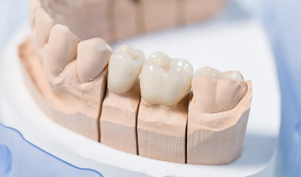 オールセラミック