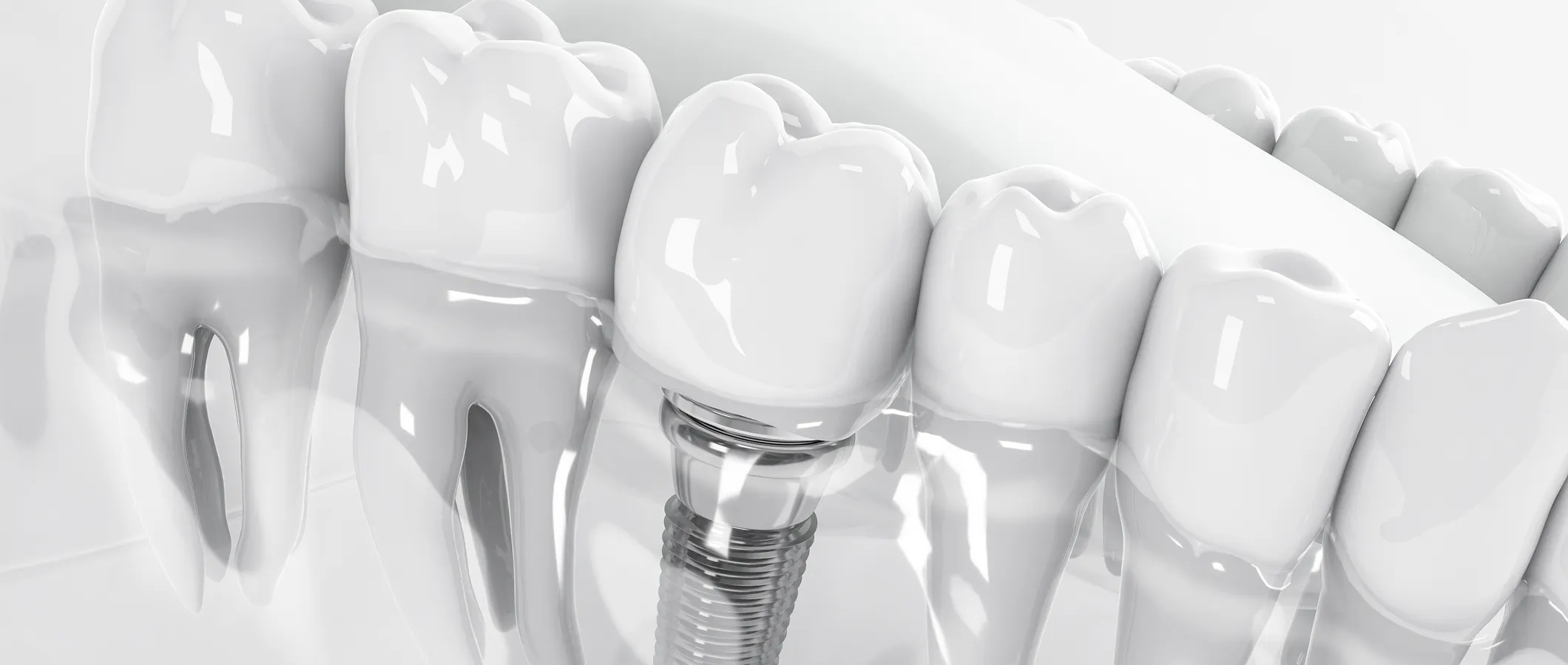 インプラント治療